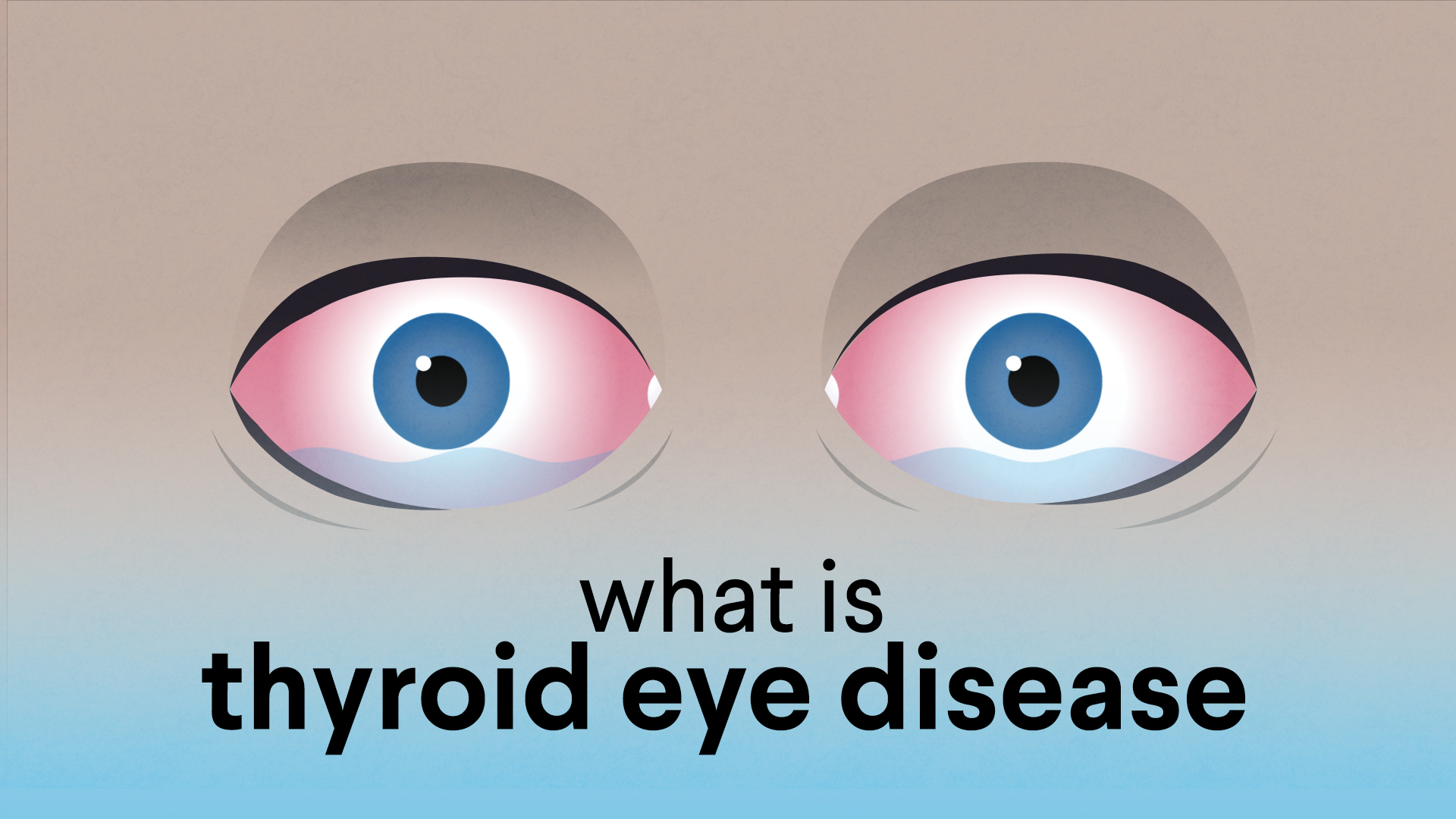 What Is Thyroid Eye Disease? | American Association of Clinical